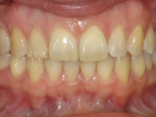 INVISALIGN AFTER